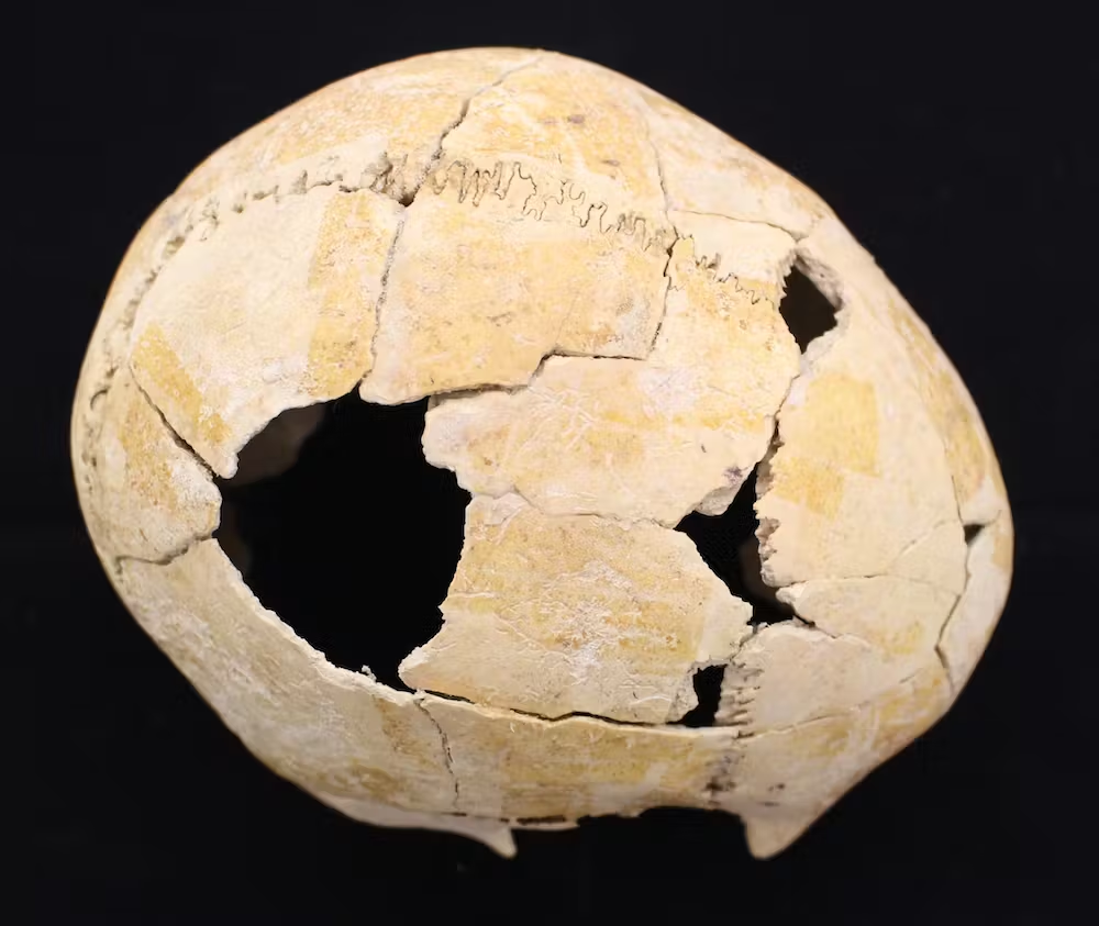 Các vết thương trên các bộ phận khác của cơ thể cũng đã được ghi nhận, cho thấy sự phụ thuộc vào bạo lực cao hơn ở nam giới.