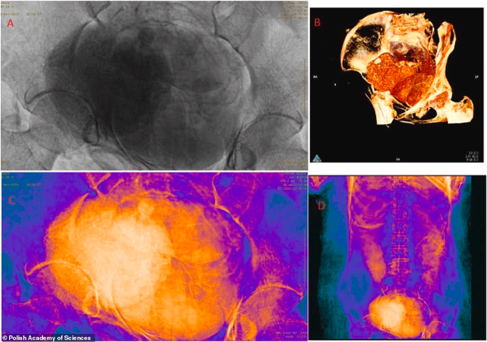 Trong trường hợp này, thai nhi trở thành một xác ướp thứ 2 trong cơ thể người phụ nữ. Các nhà nghiên cứu cho rằng những người ướp xác lúc ấy đã coi đứa bé như một phần không thể thiếu của người mẹ nên đã ướp chung.