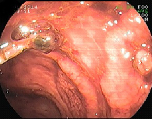 Viêm hoặc bị loét ruột. Cũng giống như ở dạ dày, niêm mạc ruột có thể sẽ bị kích ứng, viêm hoặc bị loét (là các dạng khác nhau của chứng viêm ruột). Nếu dùng gừng sẽ thúc đẩy sự kích thích thành ruột và hình thành vết loét.