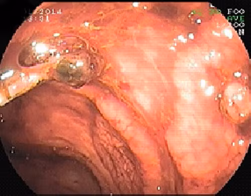 Viêm hoặc bị loét ruột. Cũng giống như ở dạ dày, niêm mạc ruột có thể sẽ bị kích ứng, viêm hoặc bị loét (là các dạng khác nhau của chứng viêm ruột). Nếu dùng gừng sẽ thúc đẩy sự kích thích thành ruột và hình thành vết loét.