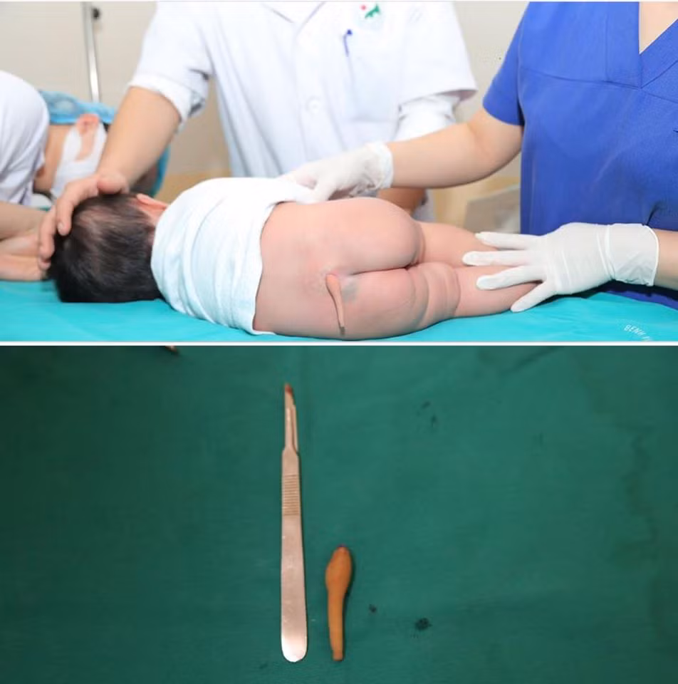 Ky tich phau thuat cat duoi hiem gap cho benh nhi 5 thang tuoi