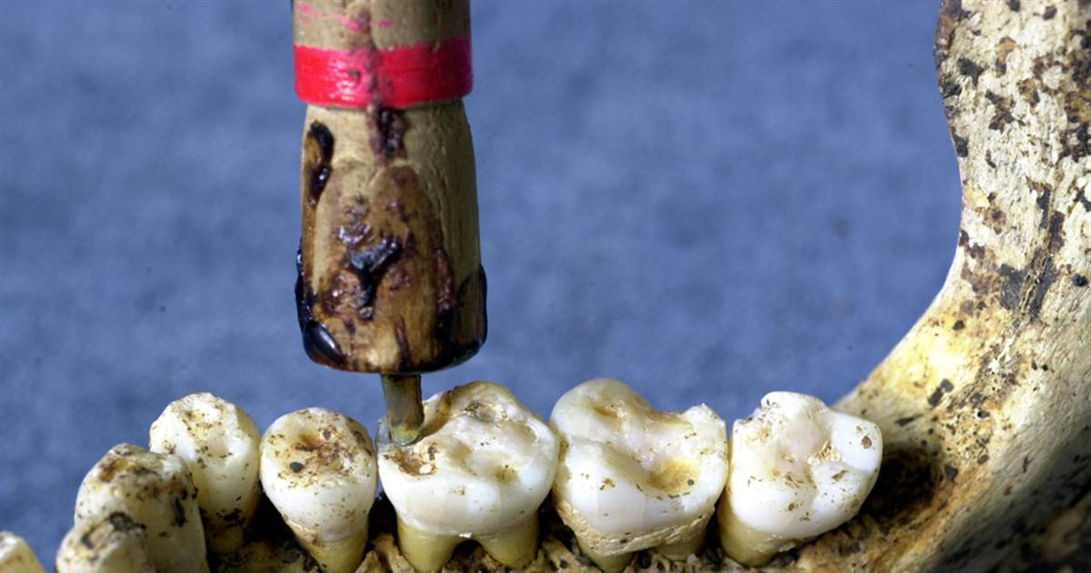 Các nhà khoa học tìm được những bằng chứng về việc con người sử dụng khoan tay hình cung để chữa các bệnh về răng từ năm 7000 trước Công nguyên.