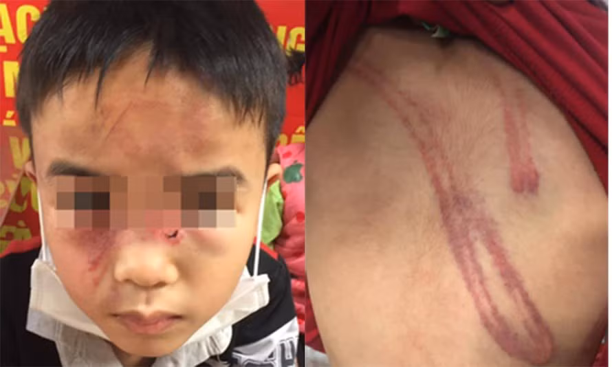  Bé trai 7 tuổi bị cha bạo hành tại Hà Nội: Đầu tháng 2/2021, một bé trai con chị Nguyễn Thị H. (trú phường Sài Đồng, quận Long Biên) được người dân phát hiện có nhiều thương tích trên người. Khi được hỏi cháu bé cho biết bị bố đánh lúc mẹ vắng nhà. Công an phường Sài Đồng cho biết, cháu bé bị cha đánh vì lấy trộm tiền.