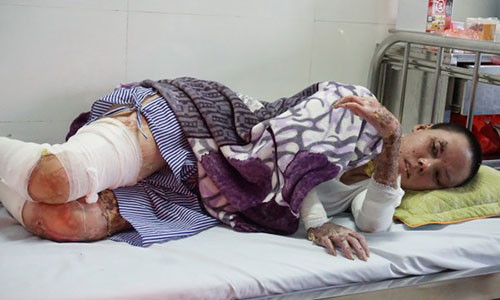 Những vết bỏng sâu khiến thân thể Lành đau đớn nhiều ngày trời.