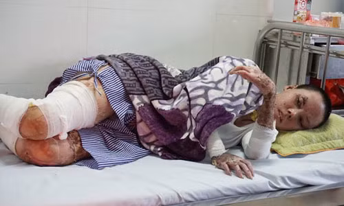 Những vết bỏng sâu khiến thân thể Lành đau đớn nhiều ngày trời.