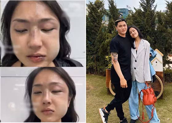 Ngày 4/12, MC kiêm diễn viên Misoa Kim Anh chia sẻ hình ảnh gương mặt bị biến dạng, sưng vù vì bị bạn trai hành hung sau khi phát hiện anh này dùng tài khoản riêng tư để nhắn tin với cô gái khác. Không chỉ Kim Anh, nhiều mỹ nhân Việt từng bị hành hung.