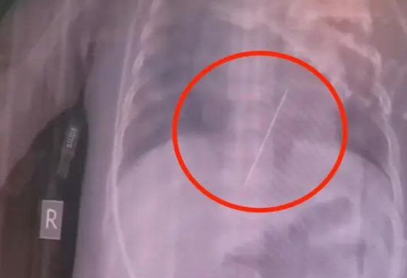 Be gai co giat du doi, hoa ra kim theu dam thang vao tim