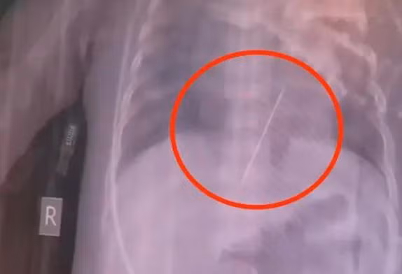 Be gai co giat du doi, hoa ra kim theu dam thang vao tim