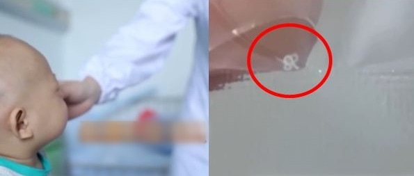 Be dui mat hon 20 ngay, bac si bat duoc 2 con giun song