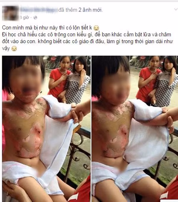 Đau xót bé mầm non bị bạn đốt bỏng nửa người Dau xot be mam non bi ban dot bong nua nguoi