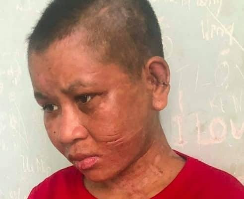 Vết thâm trên người do bị chủ nhà đánh vẫn còn tồn tại ở khuôn mặt chị Y Thiêu.