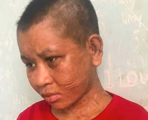 Vết thâm trên người do bị chủ nhà đánh vẫn còn tồn tại ở khuôn mặt chị Y Thiêu.