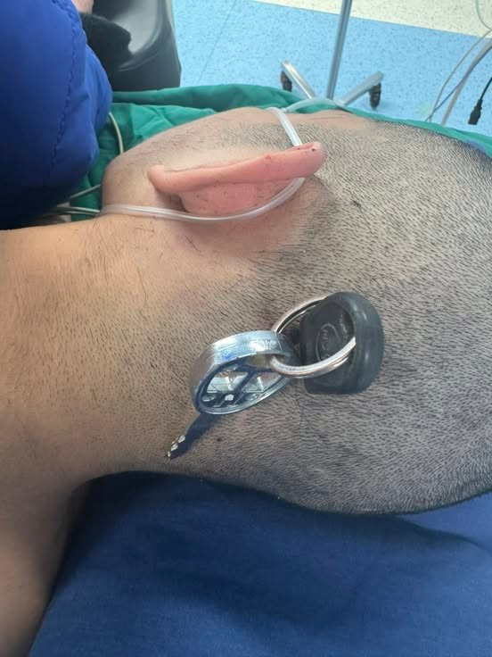 Nam hoc sinh bi chia khoa cam sau vao dau, chan thuong so nao