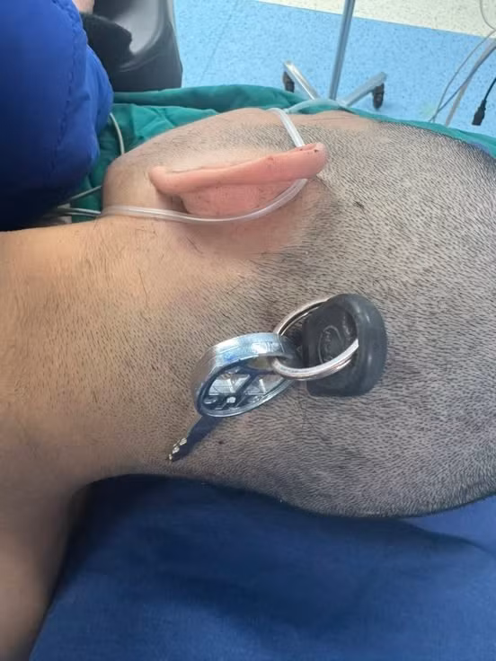 Nam hoc sinh bi chia khoa cam sau vao dau, chan thuong so nao