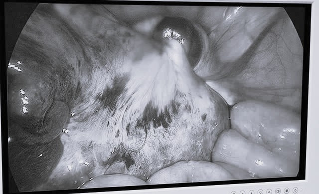 Be gai 9 tuoi khong ngo mac u buong trung xoan hiem gap