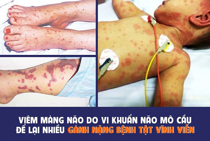 Dau hieu nhan biet som benh viem nao mo cau