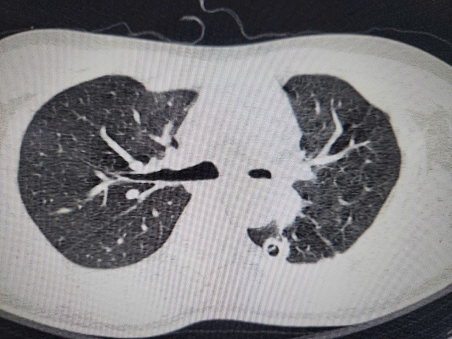 Hoi sinh la phoi xep do di chung nang ne cua benh lao phoi-Hinh-2