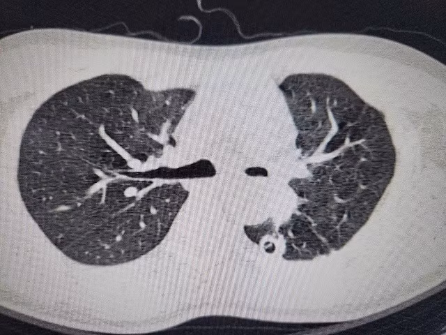 Hoi sinh la phoi xep do di chung nang ne cua benh lao phoi-Hinh-2