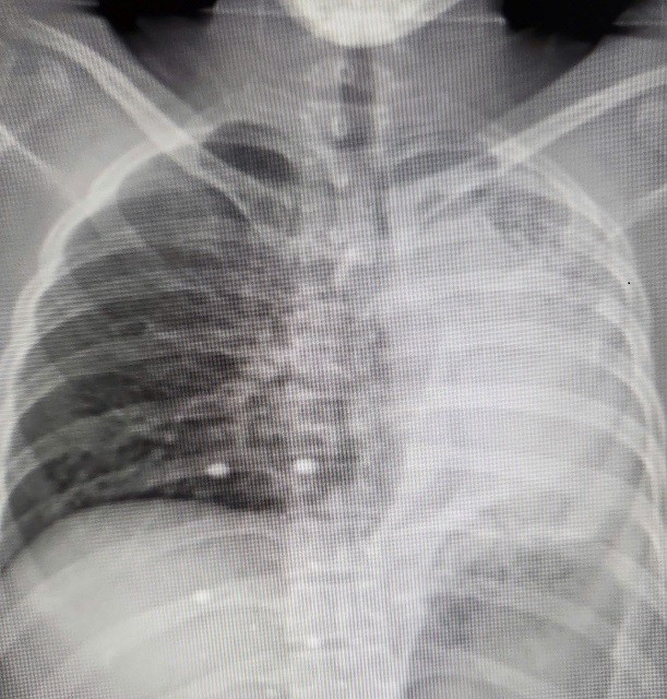 Hoi sinh la phoi xep do di chung nang ne cua benh lao phoi