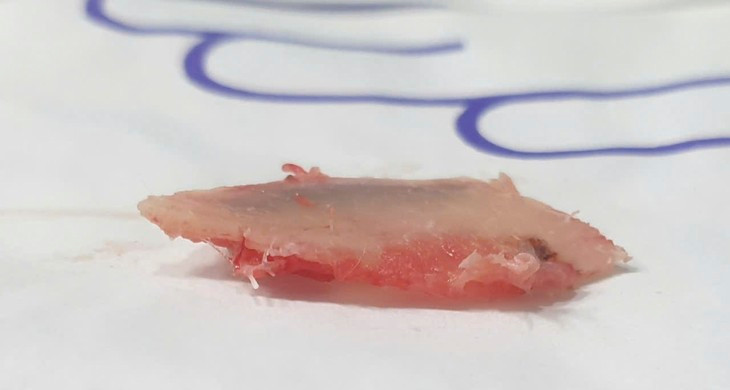 Nguoi dan ong bi xuong suon dam thung phoi-Hinh-2