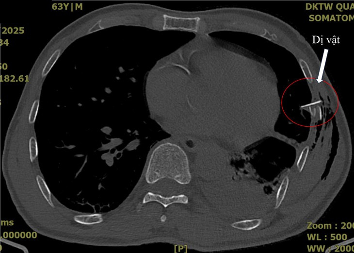 Nguoi dan ong bi xuong suon dam thung phoi