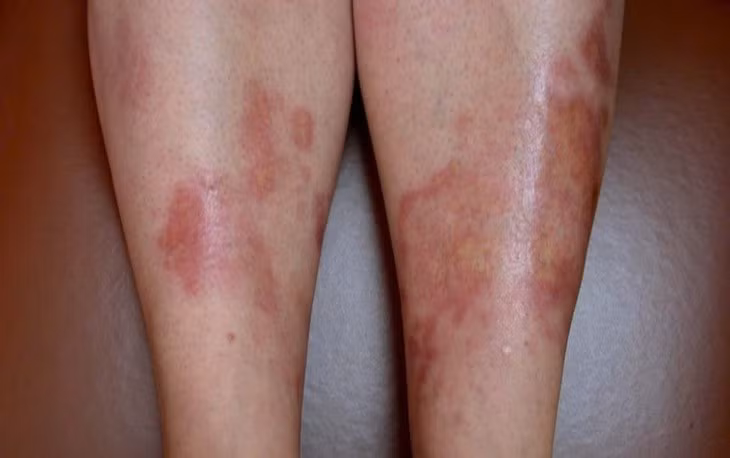 Dau hieu la tren da canh bao benh tieu duong, cho chu quan-Hinh-2