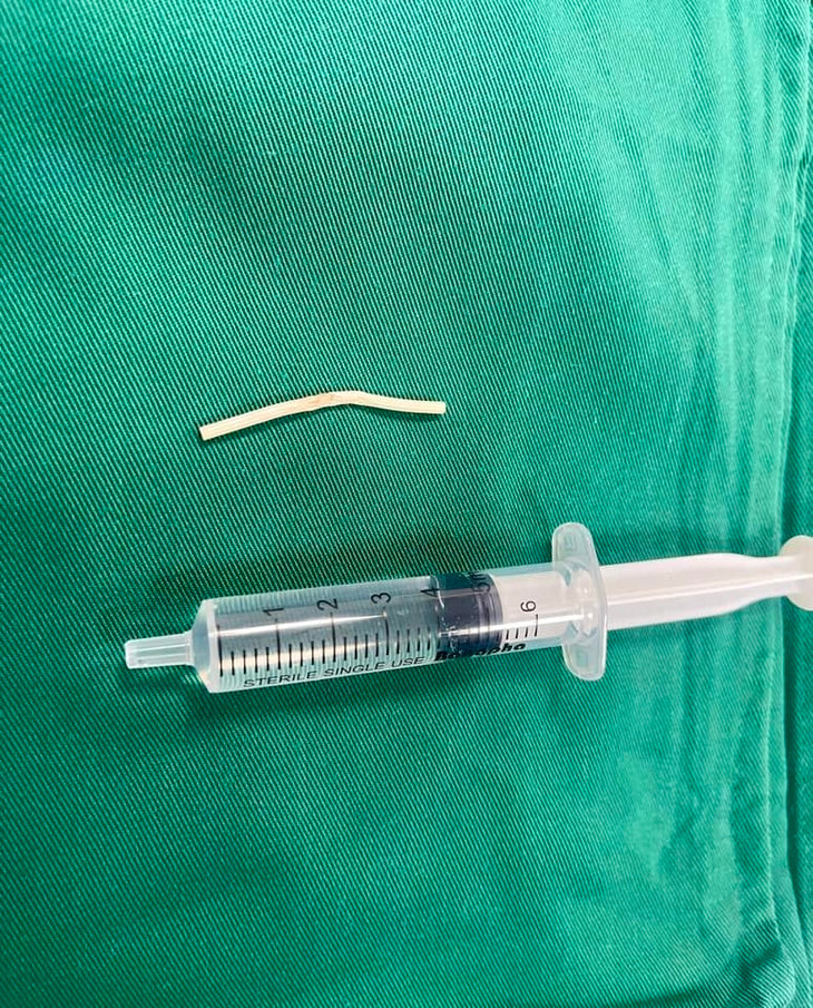 Que tranh thai di lac vao co canh tay co the gay liet-Hinh-3