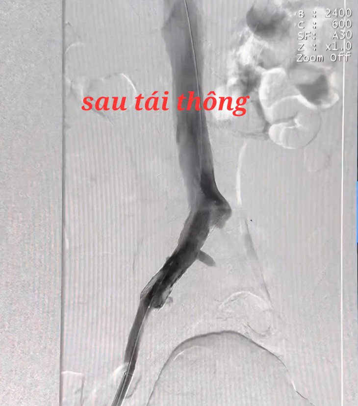 Chan dau phai mo cap cuu vi tac tinh mach chau dui cap-Hinh-3