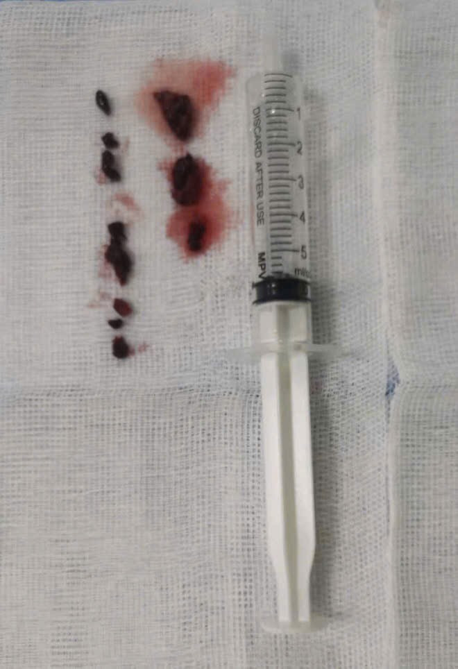 Chan dau phai mo cap cuu vi tac tinh mach chau dui cap-Hinh-2