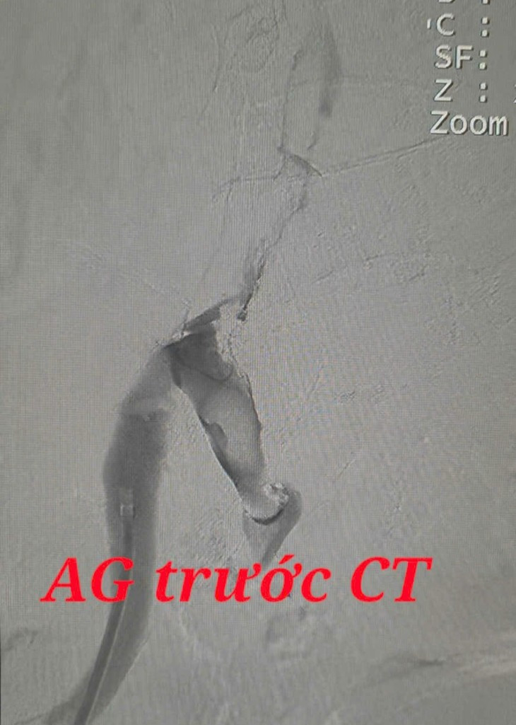 Chan dau phai mo cap cuu vi tac tinh mach chau dui cap