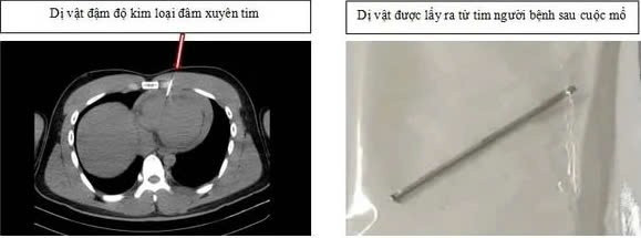 Cuu song nam thanh nien 21 tuoi bi thung tim do may ban dinh