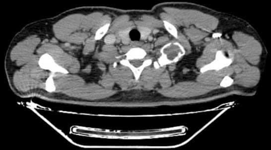 Dau tuc nhe khi van dong canh tay khong ngo u xuong suon-Hinh-2