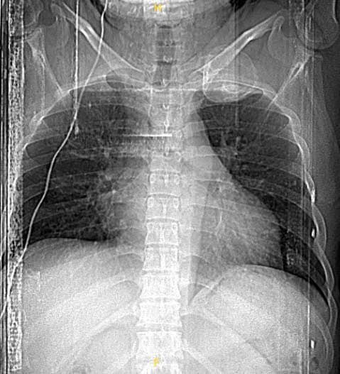 Dau tuc nhe khi van dong canh tay khong ngo u xuong suon