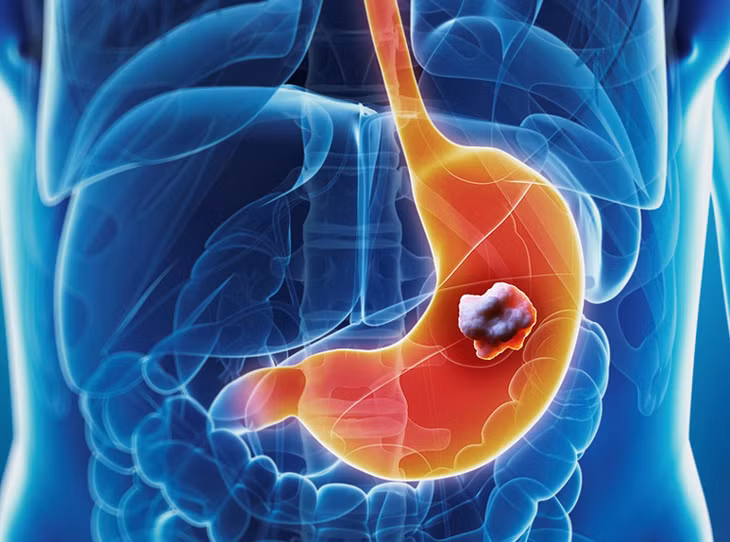 Dau hieu canh bao som ung thu da day