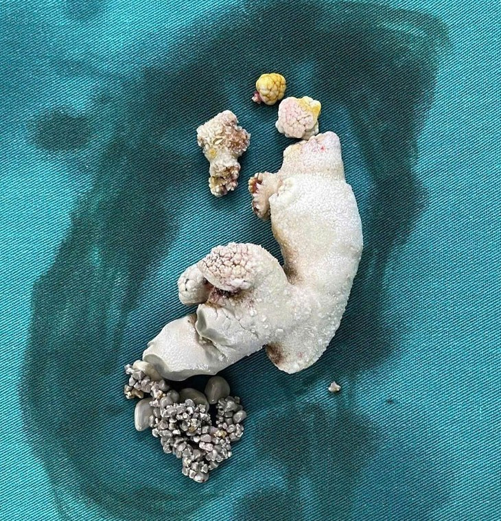 Soi san ho lon lap day than phai nguoi phu nu 65 tuoi-Hinh-2