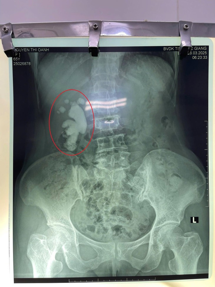 Soi san ho lon lap day than phai nguoi phu nu 65 tuoi