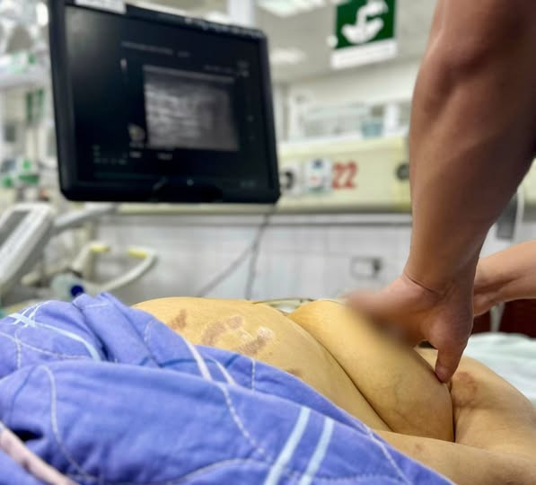 Suy gan nguy kich do chu quan voi viem gan B-Hinh-3