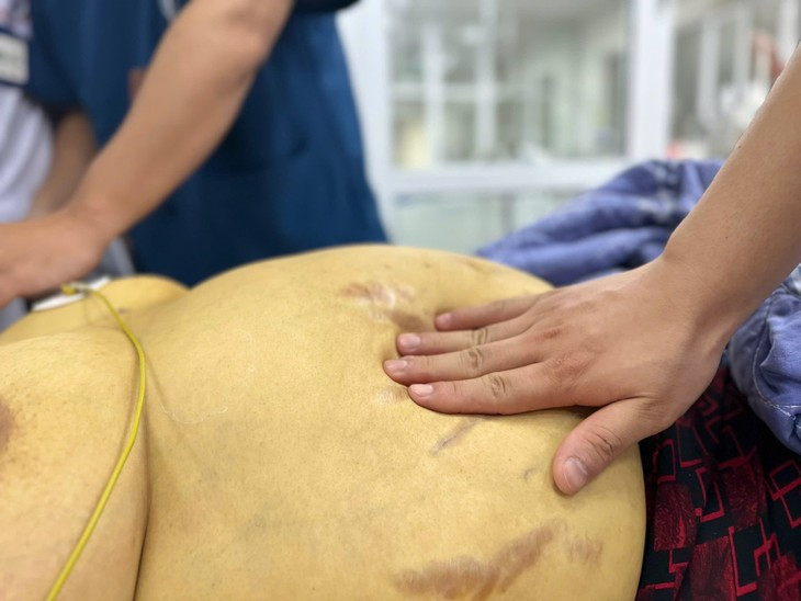 Suy gan nguy kich do chu quan voi viem gan B-Hinh-2