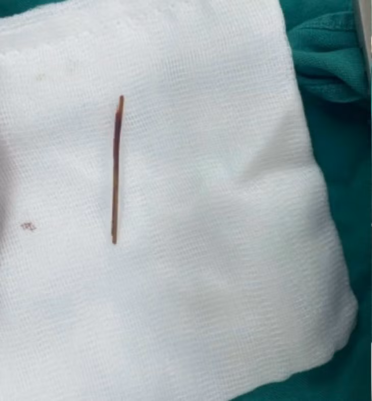 Cu ong 77 tuoi phai cat gan vi nuot tam tre dai 5 cm-Hinh-4