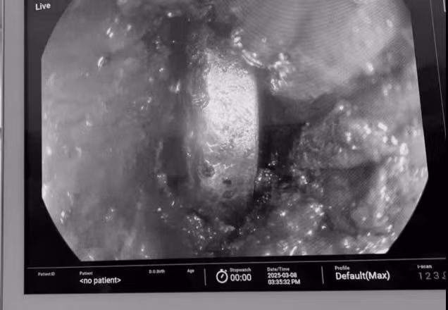 Bé 4 tuổi nuốt phải pin cúc áo suýt thủng thực quản Be 4 tuoi nuot phai pin cuc ao suyt thung thuc quan