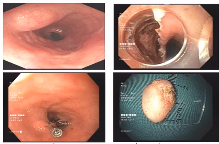 Cat bo thanh cong u co thuc quan duong mieng khong can phau thuat