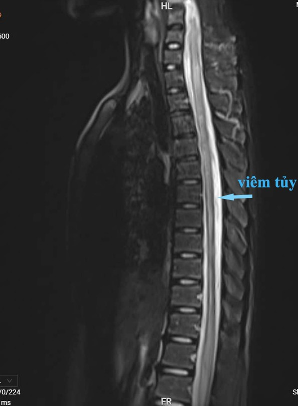 Thieu nien 14 tuoi bi viem tuy de doa liet vinh vien