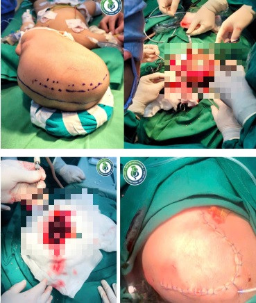 Be trai 6 thang tuoi xuat huyet nao, hon me vi dot quy-Hinh-2