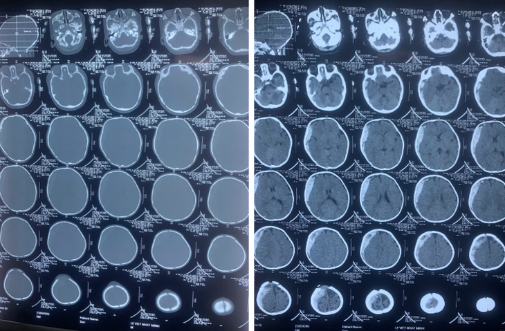Be trai 6 thang tuoi xuat huyet nao, hon me vi dot quy