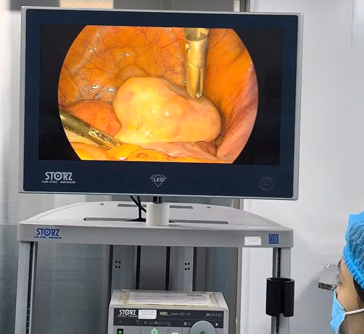 Boc tach u bi buong trung co xuong, toc cho benh nhan 35 tuoi