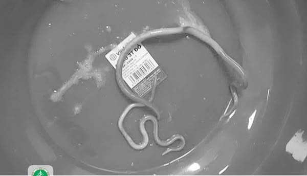 Nam benh nhan 77 tuoi bi tac ruot do giun