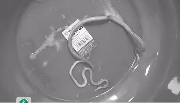 Nam benh nhan 77 tuoi bi tac ruot do giun