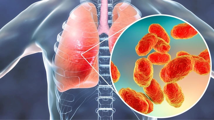 Bo Y te thong tin ve can benh chua ro nguyen nhan o Nga