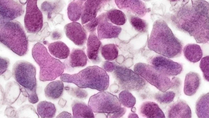 Bo Y te thong tin ve can benh chua ro nguyen nhan o Nga-Hinh-2