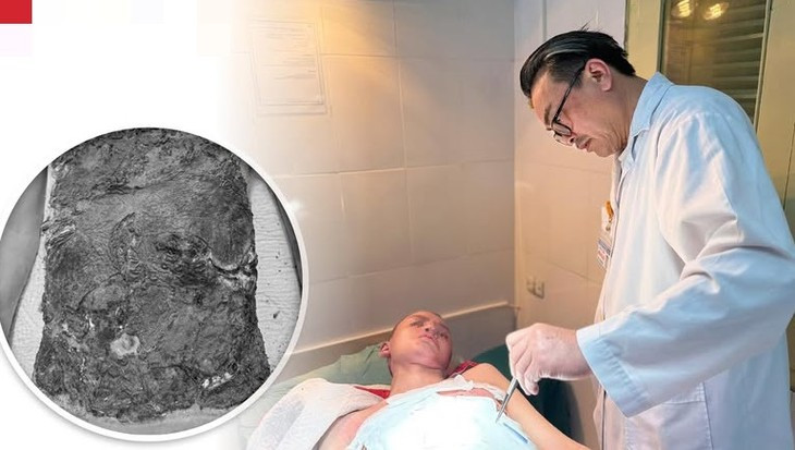 Tre 14 tuoi bi nhiem trung nang do dieu tri bong bang thuoc nam